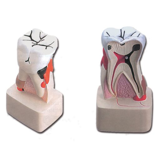 Fogbetegség oktató modell - 4X