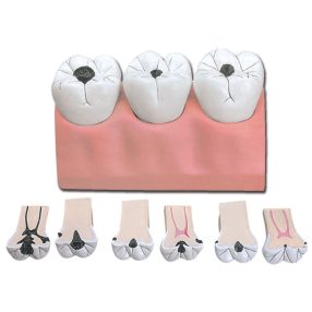 Fogszuvasodás oktató modell - 7 részes - 4x