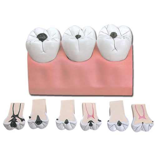 Fogszuvasodás oktató modell - 7 részes - 4x