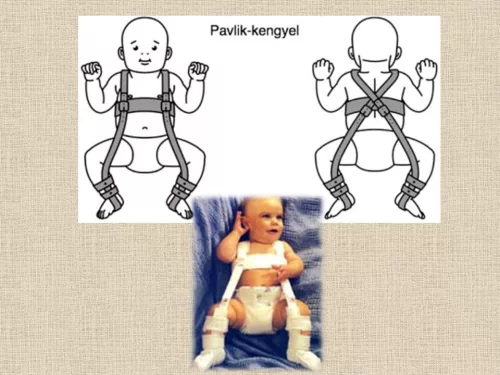 Pavlik-kengyel ppf630 2 prima protetika