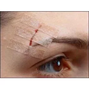 Steri-strip 6 x 75 mm bőrzáró csík 3 db csík/ív